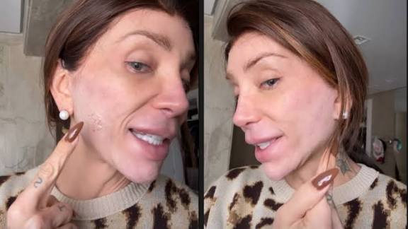 Aplicação de ácido hialurônico em clínica estética